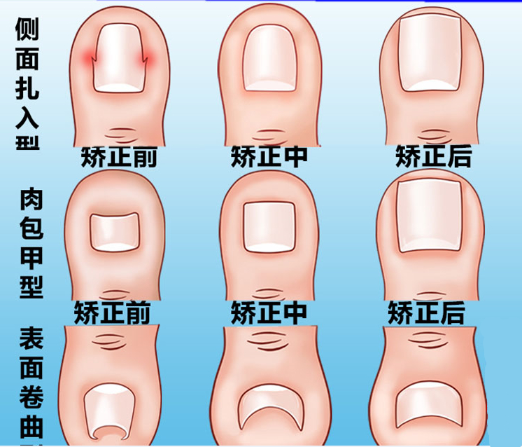 正甲贴甲沟嵌甲矫正器脚趾甲矫正贴专用指甲刀修钳套装正甲贴片炎