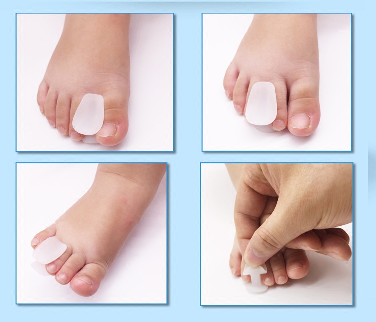 儿童脚趾矫正器 宝宝脚趾矫正器 分离器 脚趾重叠 脚趾内扣 外翻