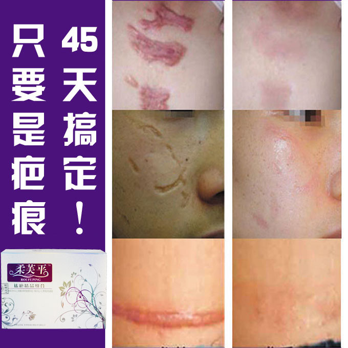 修复强效霜去疤贴去印去痕产品祛疤灵疤痕儿童凹凸 代购中国商品 华代购图片 104119 680x680