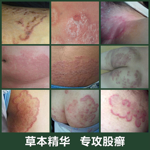 股癣特效大腿内侧瘙痒体癣真菌感染股清膏阴囊瘙痒