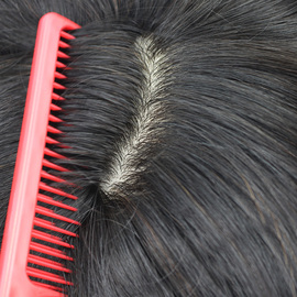 [女士头顶补发]评价 女士头顶脱发怎么样