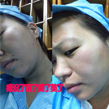 修复脱肉痣 祛脸部黑点瘊灵去除凸痣点膏净取黑痣水消痦子无痕正品