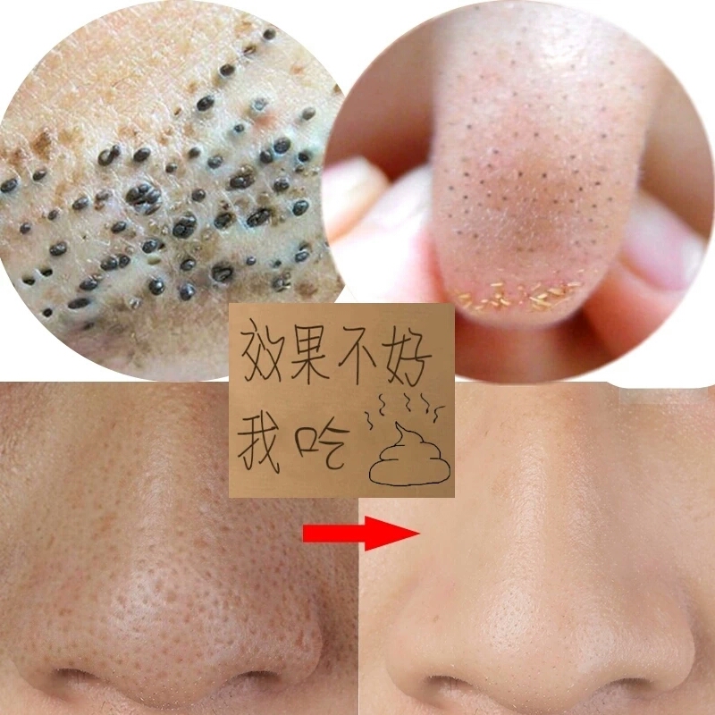 竹炭去黑头面膜撕拉式脸部收缩毛孔套装深层清洁吸祛粉刺螨虫鼻贴