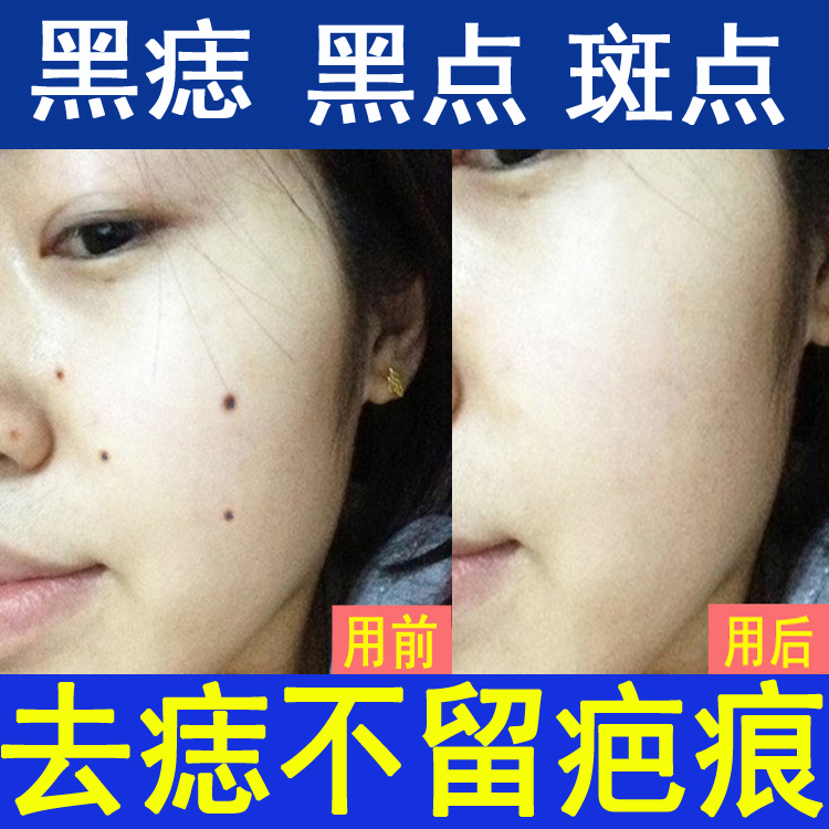 去痣点痣药水无痕正品祛痣膏韦医生除痣灵雀祛斑痦子肉黑痣点斑水