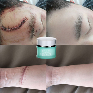 淡化疤痕灵修复疤痕膏疤痕手术刀伤疤凹凸祛去除儿童痘印正品疤克