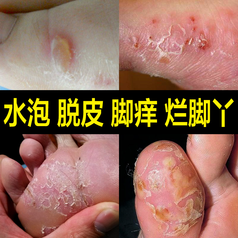 治腳氣專除腳臭腳癢水泡真菌感染止癢脫皮糜爛腳丫特效型噴劑藥膏