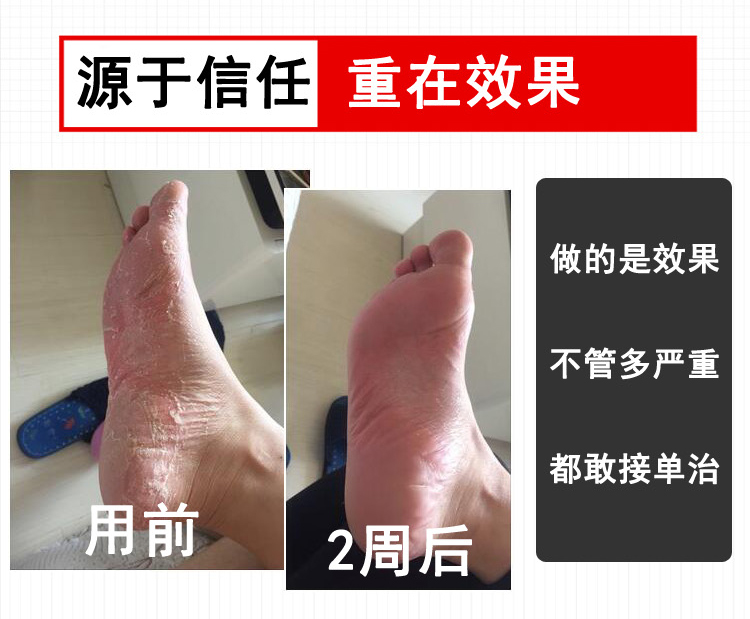 治腳氣噴劑止癢脫皮腳汗腳臭腳癢水泡型爛腳丫去除泡腳粉特效膏王