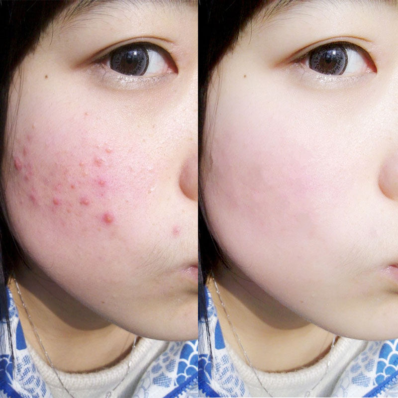 祛痘液快速去痘印痤疮青春痘闭合性粉刺痘疤去黑头男女士祛痘产品